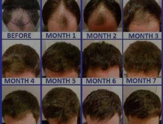 Hair loss oil